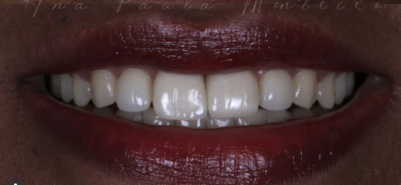 Sorriso harmonizado após tratamento estético