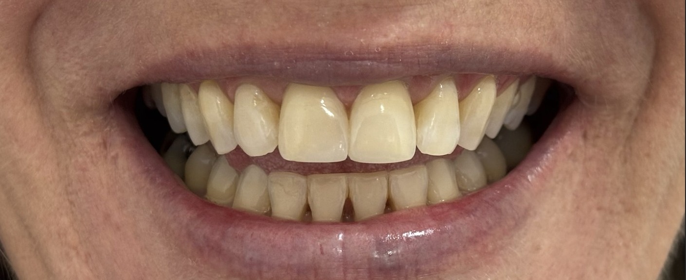 Detalhe de sorriso restaurado com resina composta