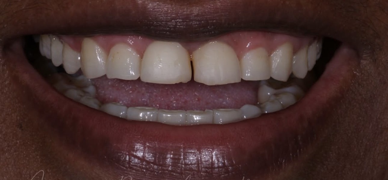 Antes — Função e estética