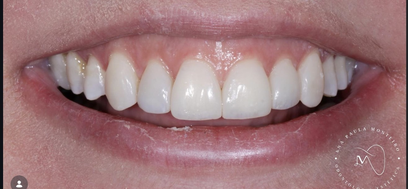 Sorriso finalizado com facetas em resina composta